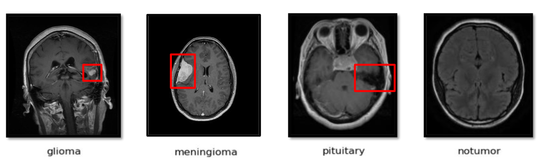 Brain tumor classification with MRI data